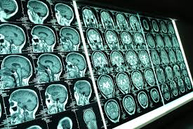 Brain Imaging using fMRI and PET scans Show how the brain reacts to trauma